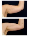 Liposuction