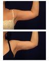 Liposuction