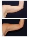 Liposuction