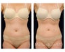 Liposuction