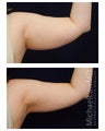 Liposuction