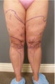 Tumescent Liposuction under local anesthesia.
