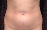 Liposuction of Abdomen