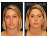 Chin Liposuction