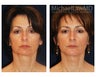 Chin Liposuction