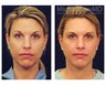 Chin Liposuction