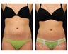 Liposuction
