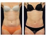Liposuction