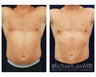 Liposuction