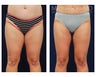 Liposuction