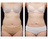 Liposuction