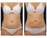 Liposuction