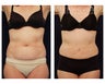 Liposuction