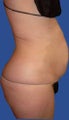 Abdomen Liposuction