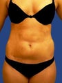 Abdomen Liposuction