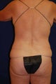 Back / Waist Liposuction