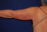 Liposuction Upper Arm
