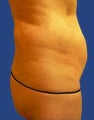 Abdomen Liposuction