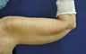 Liposuction Upper Arm