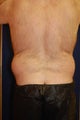 Liposuction of Waist