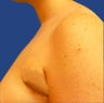 Liposuction of Underarm Area