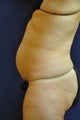 Liposuction of Abdomen