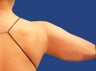 Liposuction of the Upper Arm