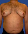 Male Breast Reduction