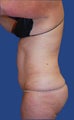 Liposuction of Abdomen