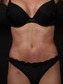 Full tummy tuck revision