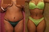 tummy tuck revision