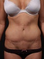 Full tummy tuck revision