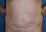 52 y/o mother of two who desired revision tummy tuck