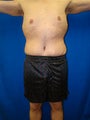 Male Tummy Tuck Surgery (abdominoplasty) Solana Beach, California
