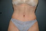 Tummy Tuck