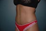 Tummy Tuck