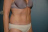 Tummy tuck