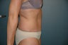 Tummy tuck
