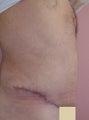 Tummy Tuck before and after