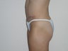 Abdominoplasty
