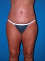 Tummy Tuck