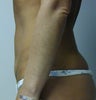 Mini abdominoplasty