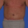 Abdominoplasty