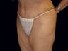 Abdominoplasty