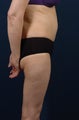 Abdominoplasty (tummy tuck)