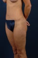 Abdominoplasty (tummy tuck)