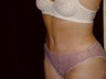Tummy Tuck