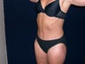Tummy Tuck and Liposuction