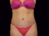 Tummy Tuck and Liposuction