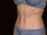 Tummy Tuck and Liposuction